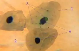 Micrograph of Chlamydia pneumoniae in an epithelial cell in acute bronchitis: 1 – infected epitheliocyte, 2 – uninfected epitheliocytes, 3 – chlamydial inclusion bodies in cell, 4 – cell nuclei