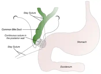 Posterior Wall Anastomosis