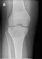 3. X-ray of chondroblastoma of large long bone of lower leg, near the knee