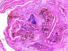 Micrograph of chromoblastomycosis showing sclerotic bodies