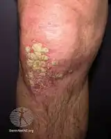 Chronic plaque psoriasis