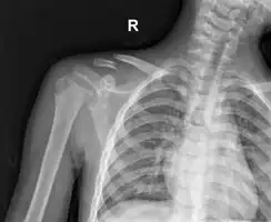 Clavicle fracture