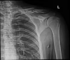 Clavicle fracture