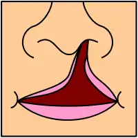 A diagram showing a complete cleft lip and palate