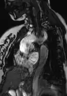 Coarctation of the aorta