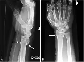 Colles fracture