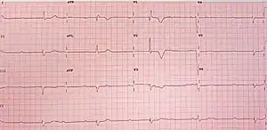 12-lead ECG showing complete heart block