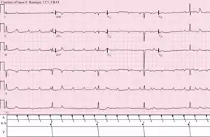 Atrial tachycardia with complete A-V block and resulting junctional escape