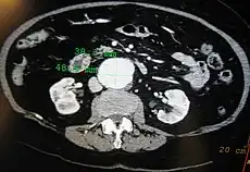 An axial contrast-enhanced CT scan demonstrating an abdominal aortic aneurysm of 4.8 by 3.8 cm