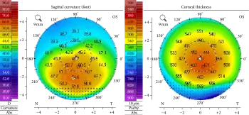 Corneal topography showing stage II keratoconus