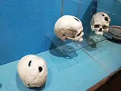 Skulls from the Bronze Age, exposed at the Musée archéologique de Saint-Raphaël (Archeological Museum of Saint-Raphaël), found in Comps-sur-Artuby (France). The subjects survived operations.