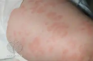 Cryopyrin-associated periodic syndrome rash