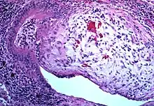 Obliterative bronchiolitis involving the terminal airways.