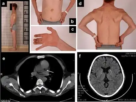 a) Thin habitus  b)gastrostomy tube  c) clawed hand d) muscle wasting  upper trunk e)calcification left coronary artery f) atrophy and calcifications of the basal ganglia