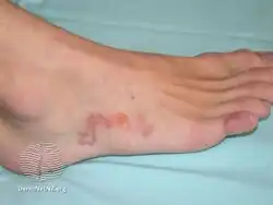 Cutaneous larva migrans