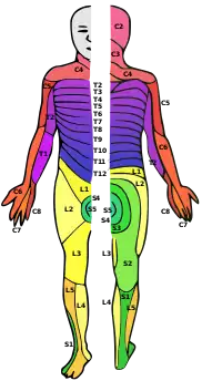 A person with dermatomes mapped out on the skin