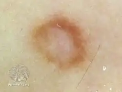 Dermatoscopy of dermatofibroma