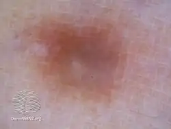 Dermatoscopy of dermatofibroma