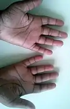 Peeling of hands