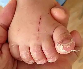 Peeling of toes