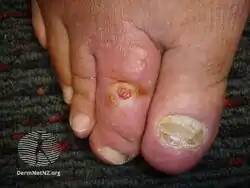 Diabetic foot ulcer