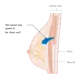 Stage 3B breast cancer