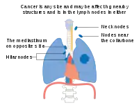 Stage IIIB lung cancer