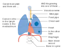 Stage IIIB lung cancer