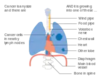 Stage IIIA lung cancer