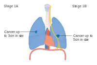 Stage IA and IB lung cancer