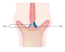 Stage 1A cervical cancer