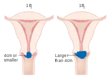 Stage 1B cervical cancer