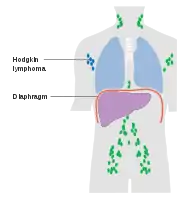 Stage 1 Hodgkin lymphoma