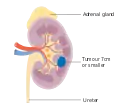 Stage 1 kidney cancer