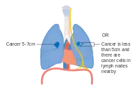 Stage IIA lung cancer