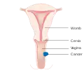 Stage 2 vaginal cancer