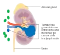 Stage 3 kidney cancer