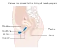 Stage 4A vulvar cancer