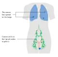 Stage 4B vulvar cancer