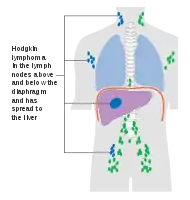 Stage 4 Hodgkin lymphoma