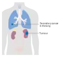 Stage 4 kidney cancer