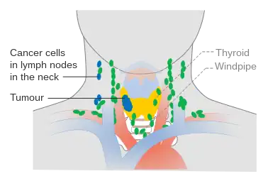 Stage N1b thyroid cancer