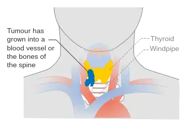 Stage T4b thyroid cancer