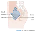 Diagram showing the area removed with an anterior operation