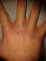 Effects of xeroderma on the hand