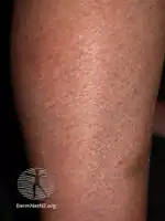 Dry skin