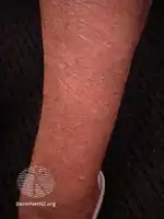 Dry skin