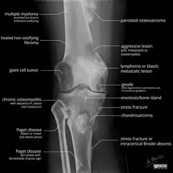 X-ray appearances of different types of bone tumors in > 30 years.