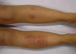 Erythema nodosum in a person who had recently had streptococcal pharyngitis