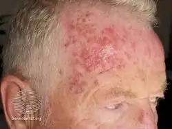 Effect of 17 days of fluorouracil cream to actinic keratoses